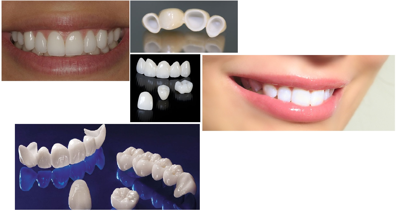 Зубные протезы из диоксида циркония — будущее стоматологии