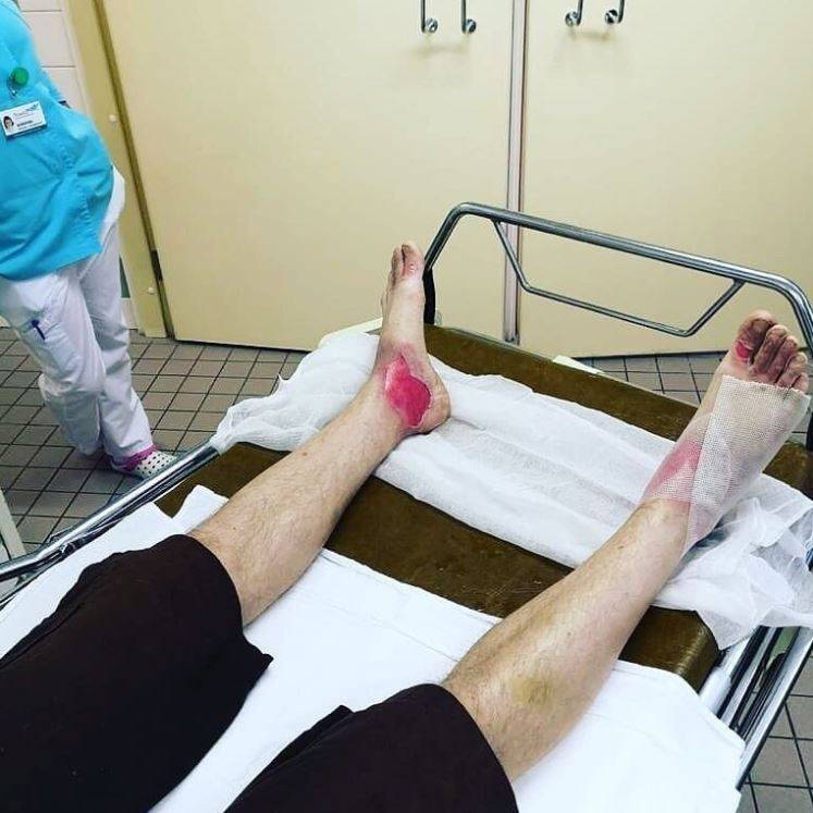 Пермская скорая опубликовала в соцсетях фото пострадавших от ядовитого сока борщевика